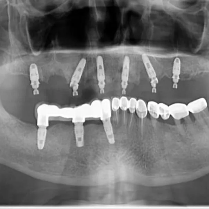 Radiografie panoramică publicată de clinică: șase implanturi în maxilarul superior și o lucrare fixă.