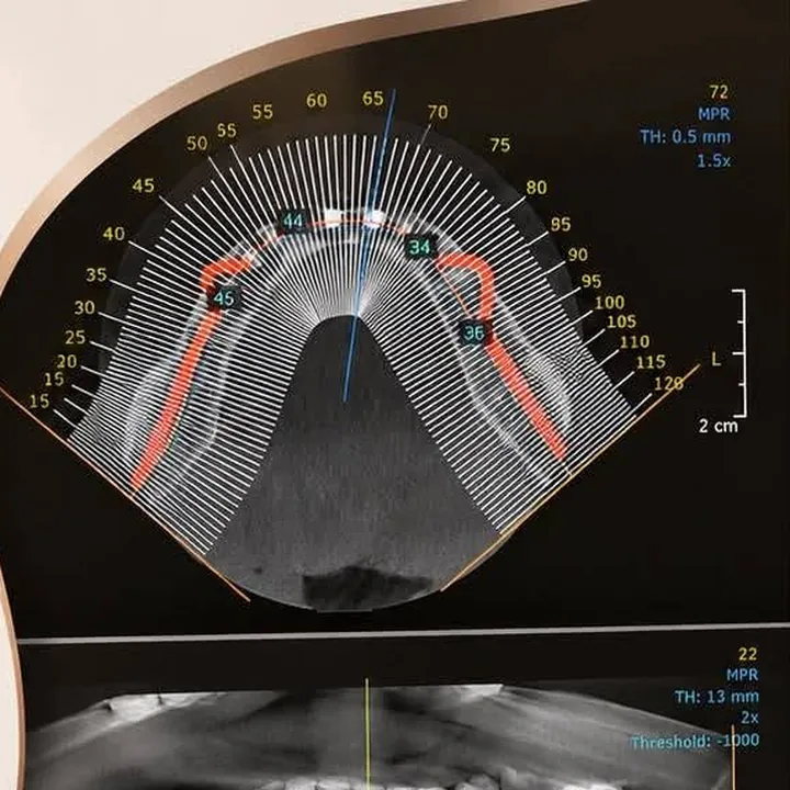 Imagine 3D (CBCT) a mandibulei, cu pozițiile implanturilor marcate, dintr-o postare a clinicii.